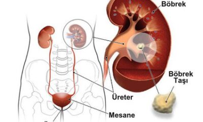 Böbrek taşlarına dikkat